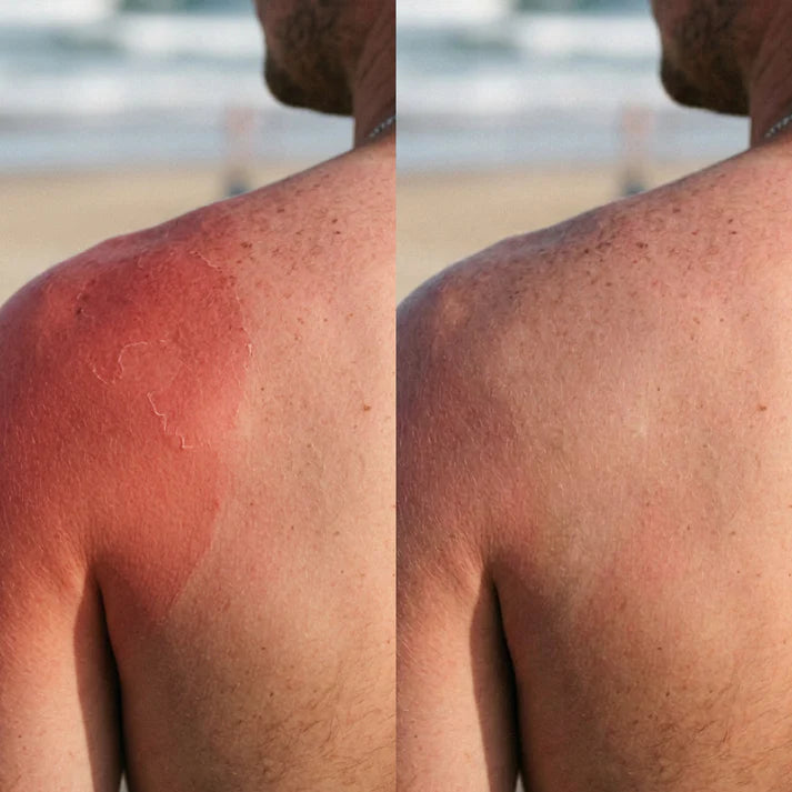 Zax's Original Burn Cream Sunburn, Chemical Burns, Minor Burns 28g